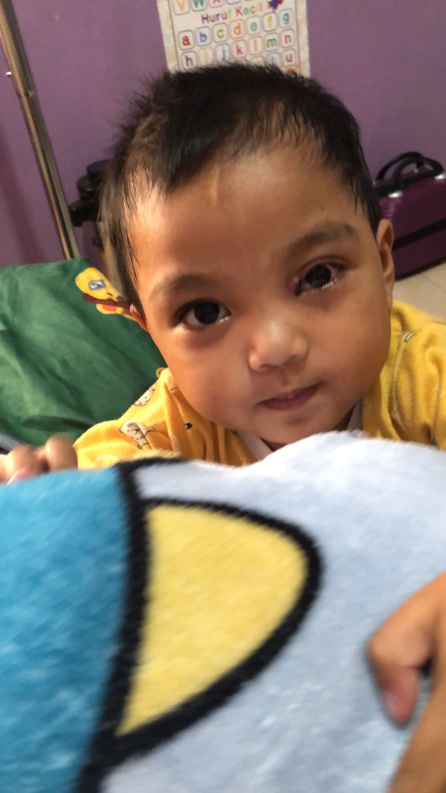 Sudah 3 Hari Mata Kenzie Bengkak