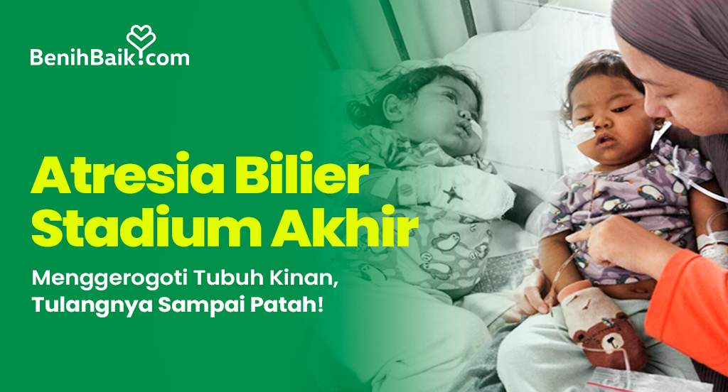 Atresia Bilier Stadium Akhir Menggerogoti Tubuh Kinan, Tulangnya Sampai Patah!