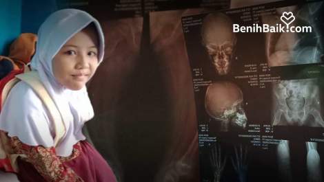 Tolong Anza! Alami Rentan Patah Tulang karena Penyakit Osteogenesis Imperfecta