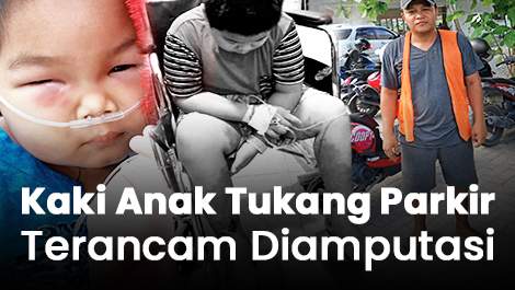 Kaki Anak Tukang Parkir Terancam Diamputasi