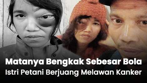 Matanya Bengkak Sebesar Bola, Istri Petani Berjuang Melawan Kanker