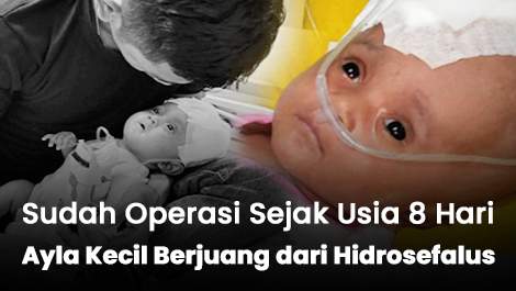 Sudah Operasi Sejak Usia 8 Hari, Ayla Kecil Berjuang dari Hidrosefalus