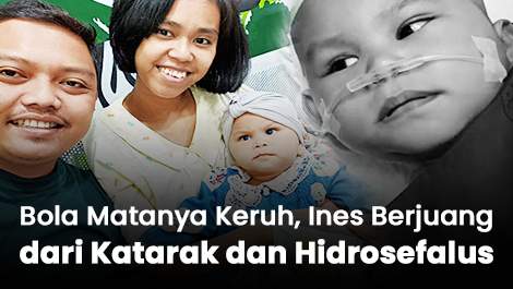 Bola Matanya Keruh, Ines Berjuang dari Katarak dan Hidrosefalus