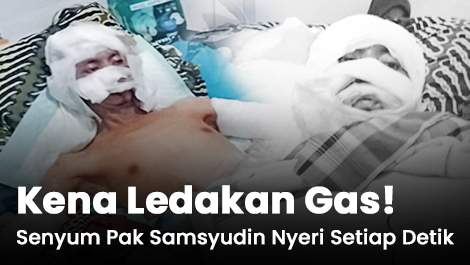 Kena Ledakan Gas! Senyum Pak Samsyudin Berganti Rasa Nyeri Setiap Detik