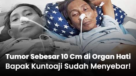 Tumor Sebesar 10 Cm di Organ Hati Bapak Kuntoaji Sudah Menyebar!