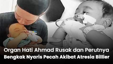 Organ Hati Ahmad Rusak dan Perutnya Bengkak Nyaris Pecah Akibat Atresia Billier