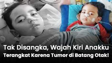 Tak Disangka, Wajah Kiri Anakku Terangkat Karena Tumor di Batang Otak!