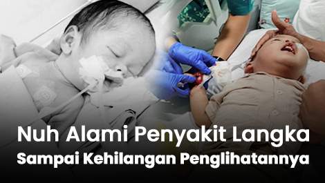 Nuh Alami Penyakit Langka Sampai Kehilangan Penglihatannya