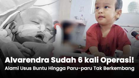 Sudah 6 kali Operasi! Alvarendra Alami Usus Buntu Hingga Paru-paru Tak Berkembang