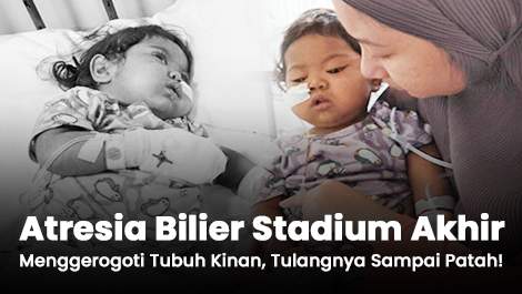 Atresia Bilier Stadium Akhir Menggerogoti Tubuh Kinan, Tulangnya Sampai Patah!