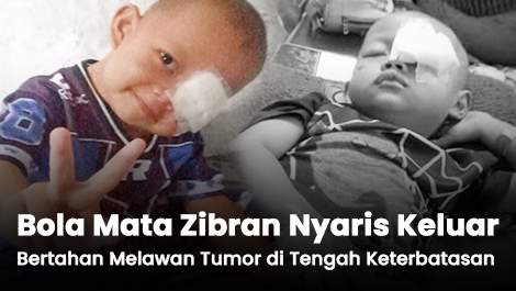 Bola Matanya Nyaris Keluar, Zibran Bertahan Melawan Tumor di Tengah Keterbatasan