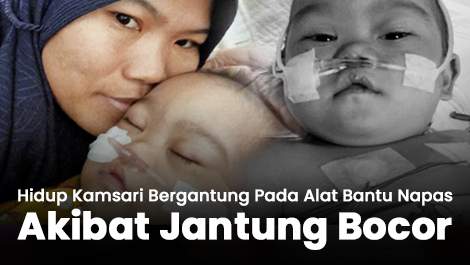 Hidup Kamsari Bergantung Pada Alat Bantu Napas Akibat Jantung Bocor