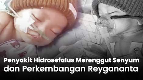 Penyakit Hidrosefalus Merenggut Senyum dan Perkembangan Reygananta