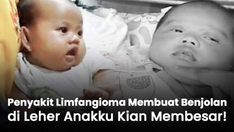Penyakit Limfangioma Membuat Benjolan di Leher Anakku Kian Membesar!