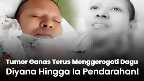 Tumor Ganas Terus Menggerogoti Dagu Diyana Hingga Ia Pendarahan!