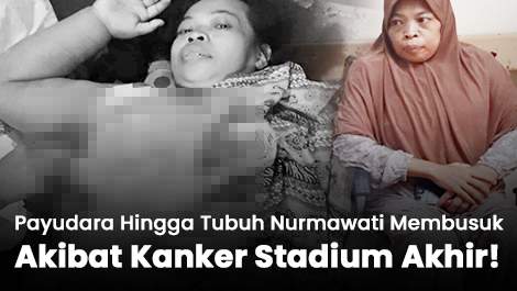 Payudara Hingga Tubuh Nurmawati Membusuk Akibat Kanker Stadium Akhir!