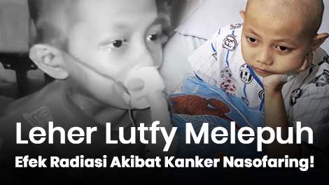 Leher Anak Berprestasi Melepuh Efek Radiasi Akibat Kanker Nasofaring!
