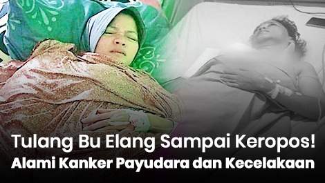 Tulangnya Sampai Keropos! Bu Elang Alami Kanker Payudara dan Kecelakaan