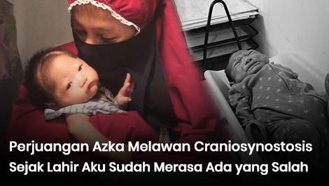 Sejak Lahir Aku Sudah Merasa Ada yang Salah, Kini Azka Berjuang Melawan Craniosynostosis