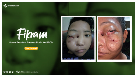 Fikram Harus Berobat Secara Rutin Ke Rscm