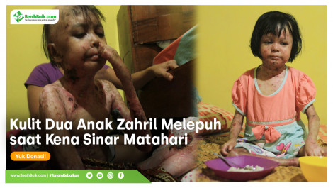 Kulit Dua Anak Zahril Melepuh Saat Kena Sinar Matahari