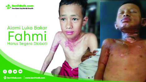 Alami Luka Bakar, Fahmi Harus Segera Diobati