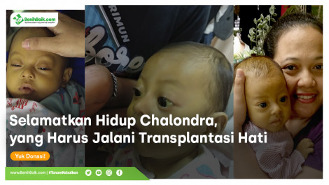 Selamatkan Chalondra yang Harus Menjalani Transplantasi Hati