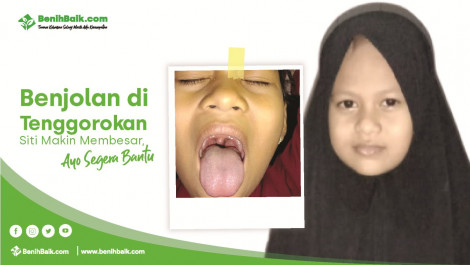 Benjolan Di Tenggorokan Siti Makin Membesar, Ayo Segera Bantu