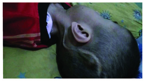 Pertumbuhan Arya Lambat Karena Hidrosefalus