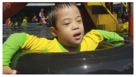 Irfan Hanif Perlu Terapi Down Syndrome