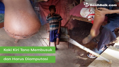 Kaki Kiri Tano Membusuk dan Harus Diamputasi