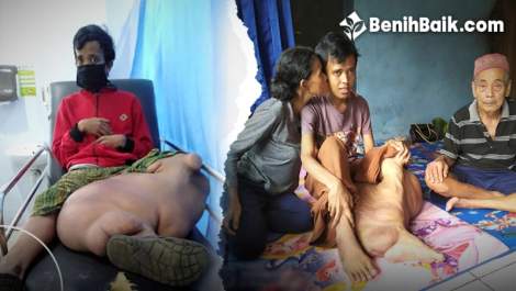 Kaki Gajah Akut Merenggut Keceriaan Masa Muda Wahyu