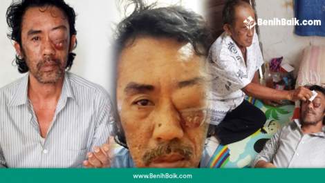 Bantu Suryadi Terbebas Dari Tumor Mata Ganas